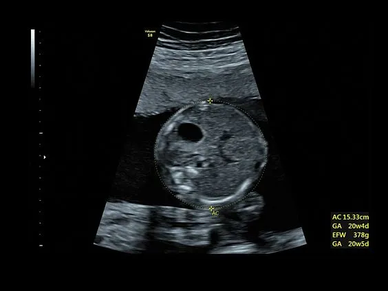 Клинические изображения GE Voluson S8 ультразвуковой аппарат