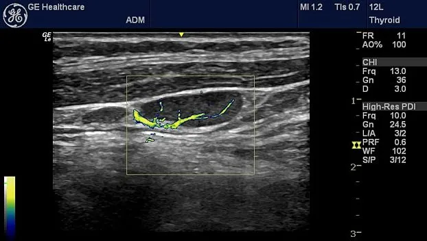 Клинические изображения Портативная ультразвуковая система GE HealthCare Logiq e