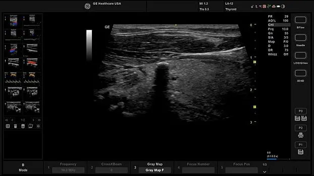 Клинические изображения GE HealthCare Versana Balance R2 УЗИ аппарат