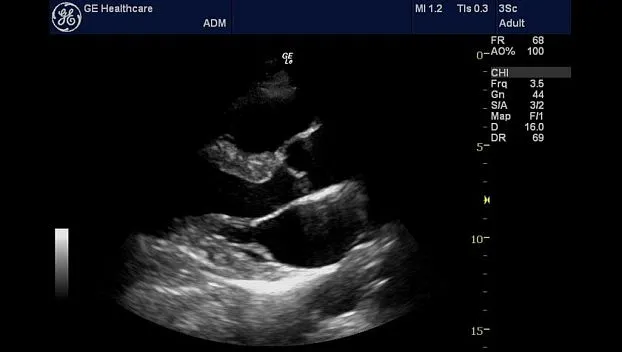 Клинические изображения Портативная ультразвуковая система GE HealthCare Logiq e