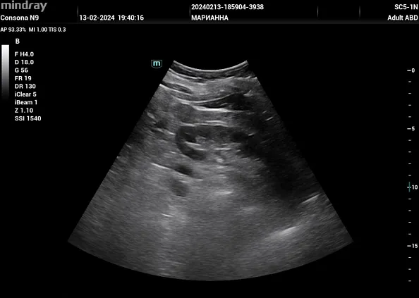 Клинические изображения УЗИ аппарат Mindray Consona N9