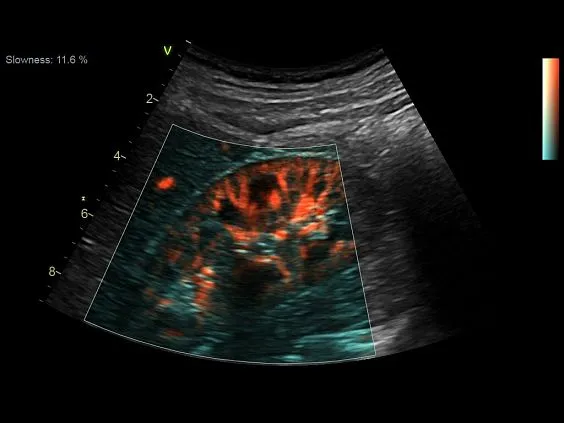 Клинические изображения GE Vivid S70 УЗИ аппарат