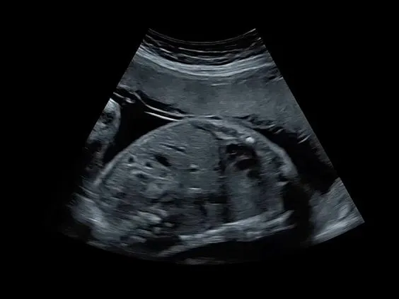 Клинические изображения GE Voluson S8 ультразвуковой аппарат