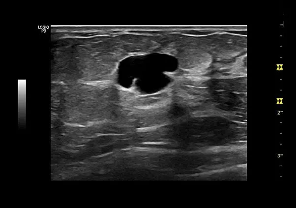 Клинические изображения GE Logiq P9 ультразвуковая диагностическая система