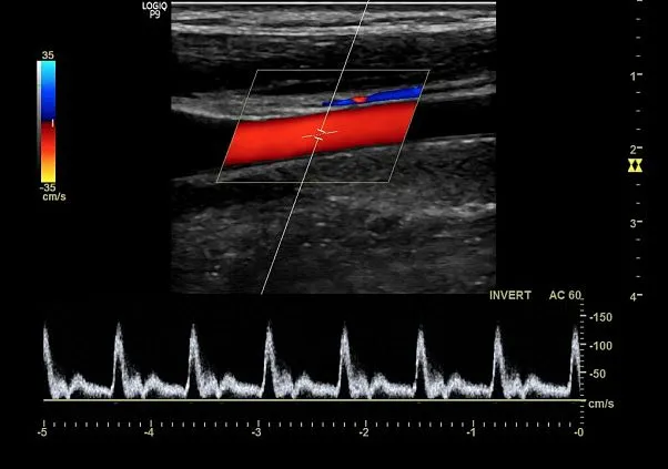 Клинические изображения GE Logiq P9 ультразвуковая диагностическая система