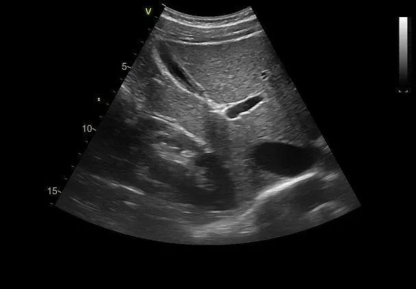 Клинические изображения Ультразвуковая диагностическая система GE HealthCare Vivid T8