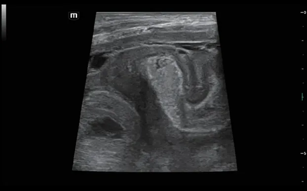 Клинические изображения УЗИ аппарат Mindray Resona i9
